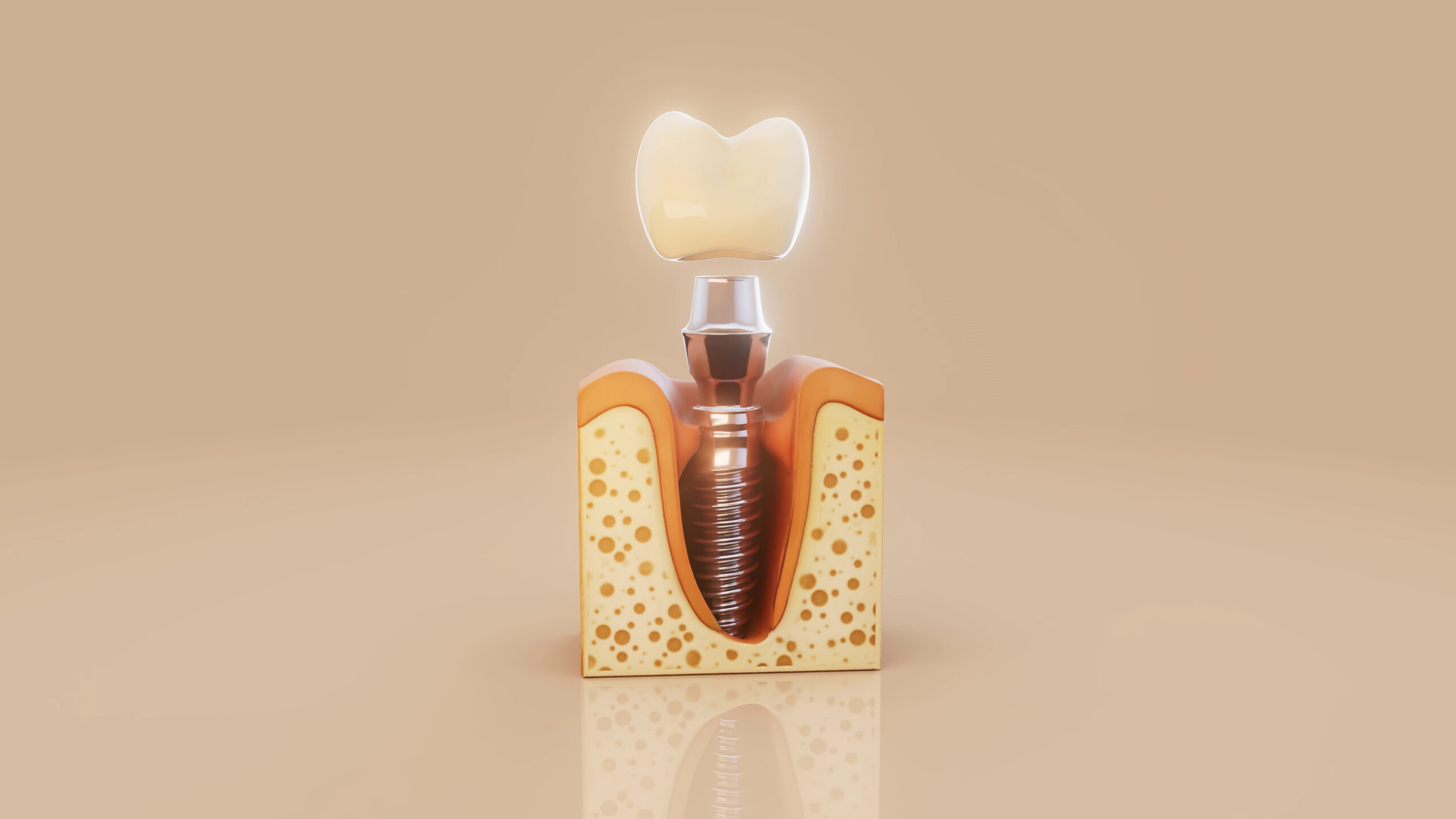 Implantes Dentales Premium: ¿Por qué cuestan más y qué ofrecen?